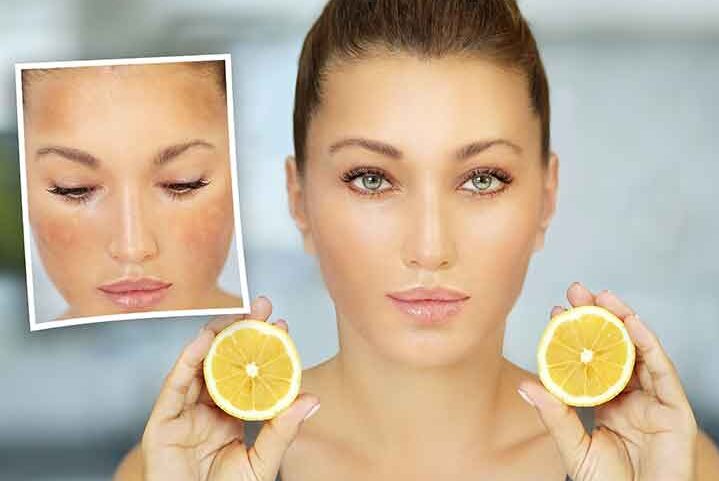 Goodbye to Dark Spots: A Natural Solution with Lemon Juice